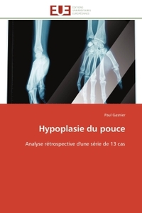 HYPOPLASIE DU POUCE - ANALYSE RETROSPECTIVE D'UNE SERIE DE 13 CAS