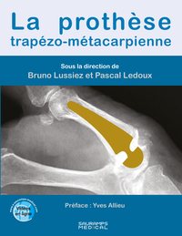 LA PROTHESE TRAPEZO-METACARPIENNE