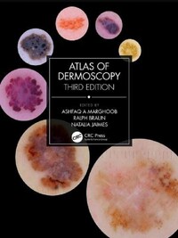 ATLAS OF DERMOSCOPY