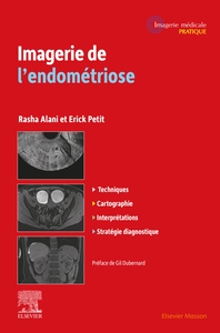 IMAGERIE DE L'ENDOMETRIOSE