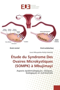 etude du Syndrome Des Ovaires Microkystiques (SOMPK) a Mbujimayi