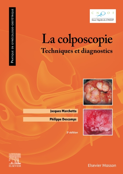 La colposcopie - Techniques et diagnostics