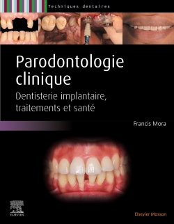 Parodontologie clinique - Dentisterie implantaire, traitements et santé