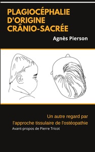 Image de plagiocéphalie d'origine crânio-sacrée