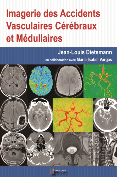 Image de IMAGERIE DES ACCIDENTS VASCULAIRES CEREBRAUX ET MEDULLAIRES