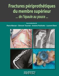 Image de Fractures périprothétiques du membre supérieur...de l'épaule au pouce...