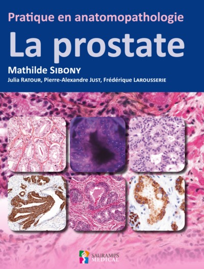 Picture of PRATIQUE EN ANATOMOPATHOLOGIE - LA PROSTATE