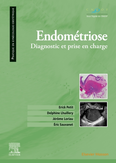 Picture of Endométriose