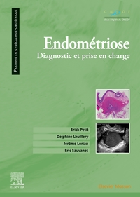 Picture of Endométriose