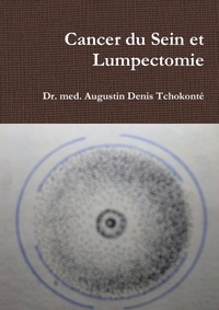 Image de Cancer du Sein et Lumpectomie