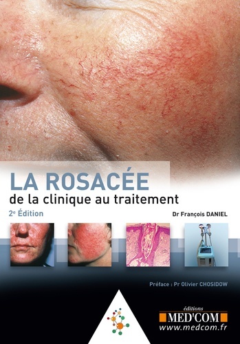 Picture of LA ROSACEE. DE LA CLINIQUE AU TRAITEMENT