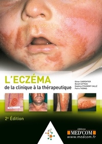 Picture of L ECZEMA. DE LA CLINIQUE AU TRAITEMENT. 2  ED