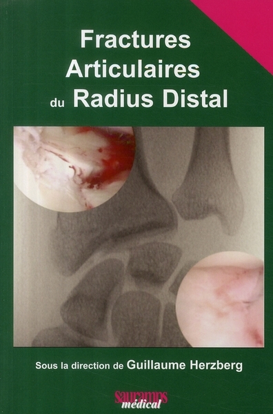 Picture of FRACTURES ARTICULAIRES DU RADIUS DISTAL