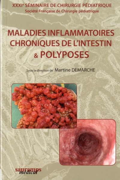 Picture of MALADIES INFLAMMATOIRES CHRONIQUES DE L'INTESTIN & POLYPOSES