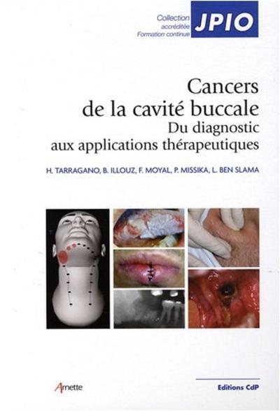 Cancers de la cavité buccale, Du diagnostic aux applications thérapeutiques (9782843611292-front-cover)