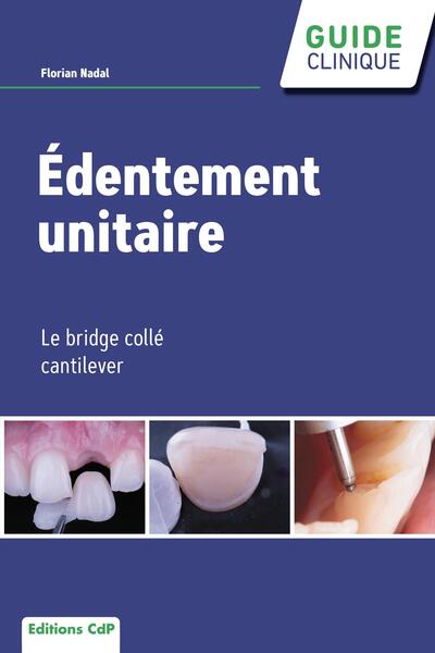 Edentement unitaire - Le bridge collé cantilever (9782843614613-front-cover)