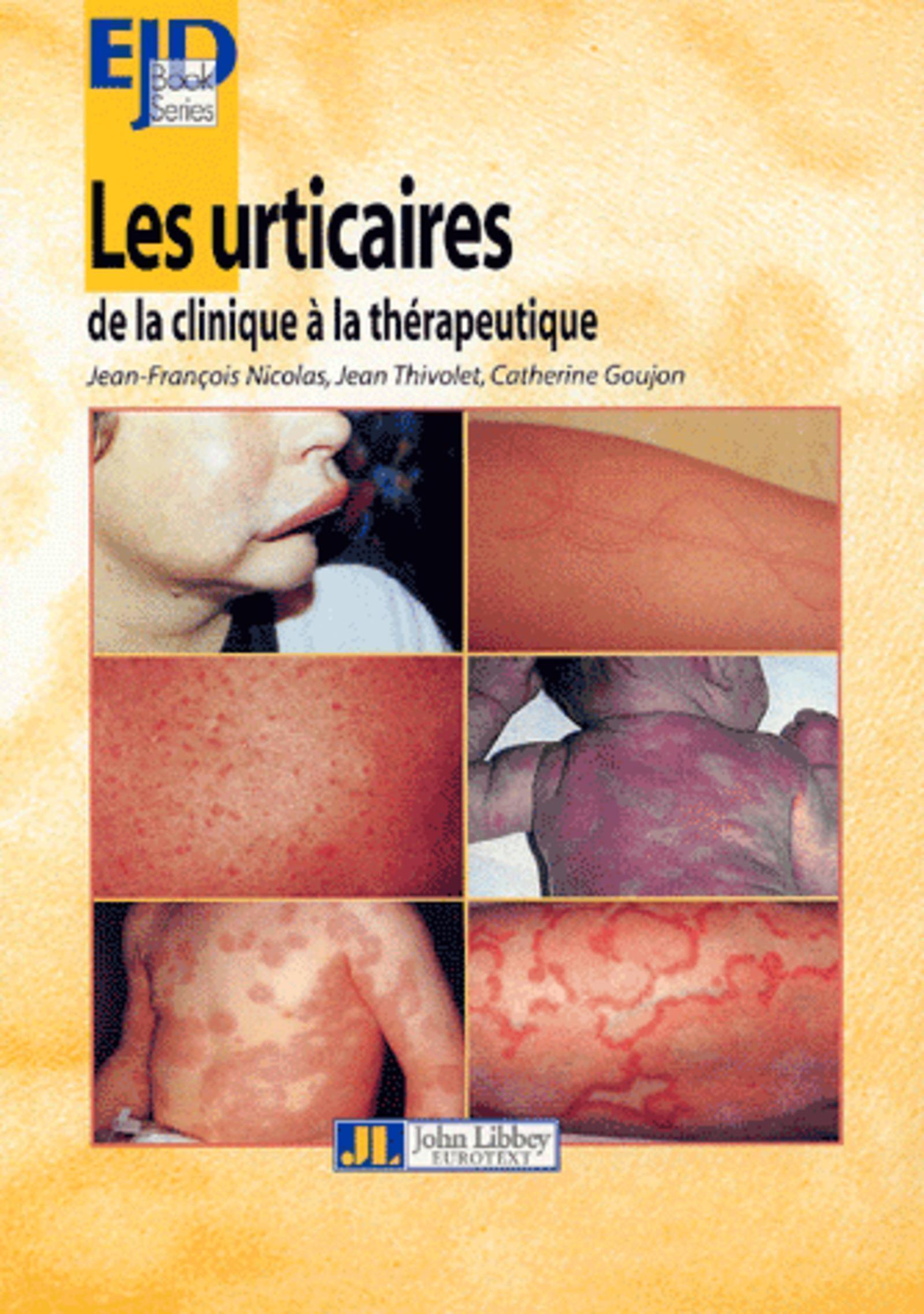 Les Urticaires-De La Clinique A La Therapeutique (9782742003556-front-cover)