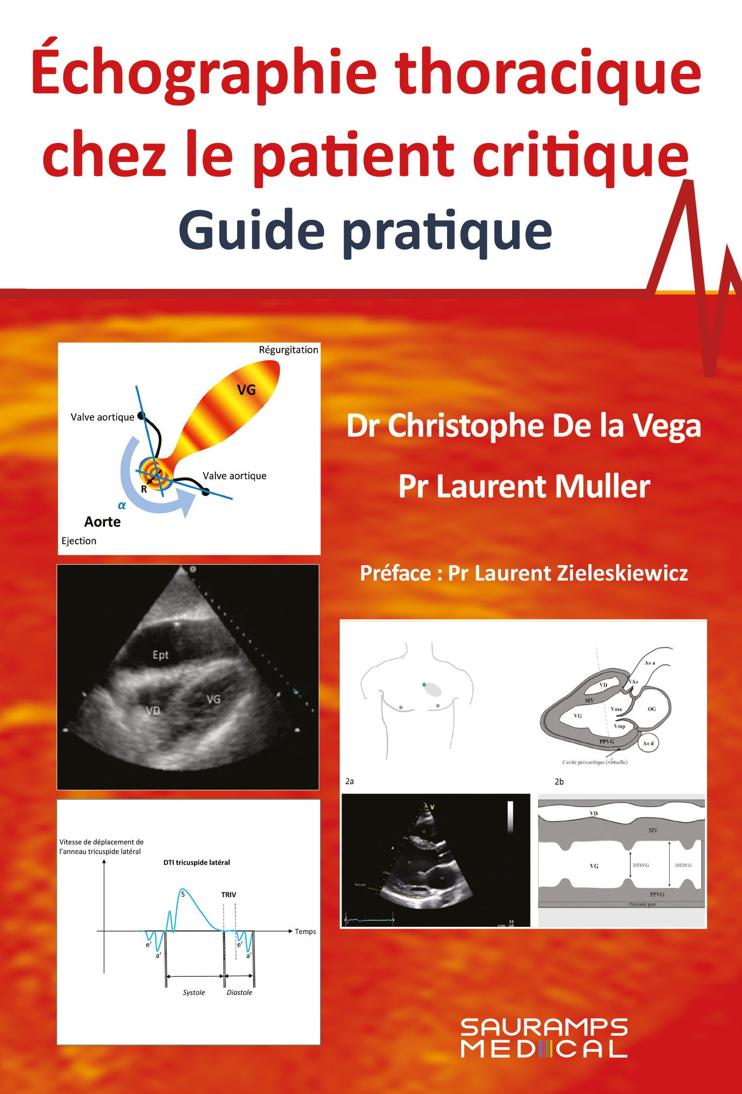Echographie thoracique chez le patient critique- Guide pratique (9791030304794-front-cover)