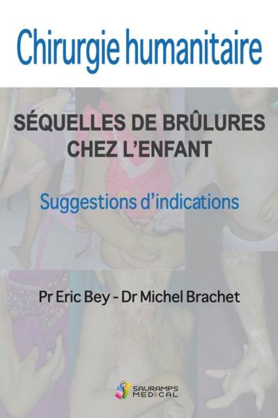 CHIRURGIE HUMANITAIRE. SEQUELLES DE BRULURES CHEZ L ENFANT, SUGESSIONS D INDICATIONS (9791030302868-front-cover)