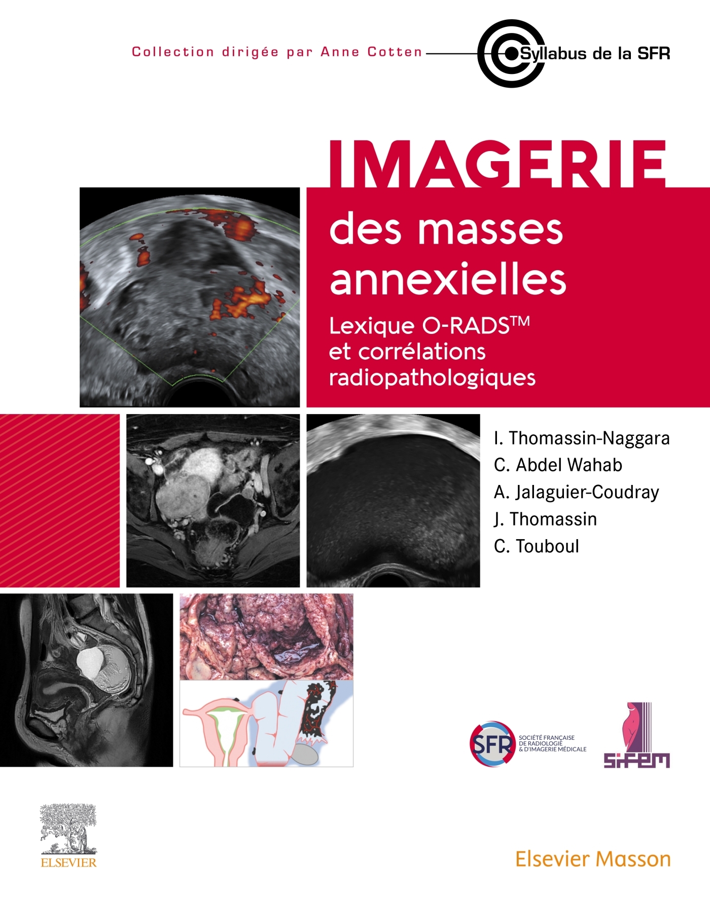 Imagerie des masses annexielles