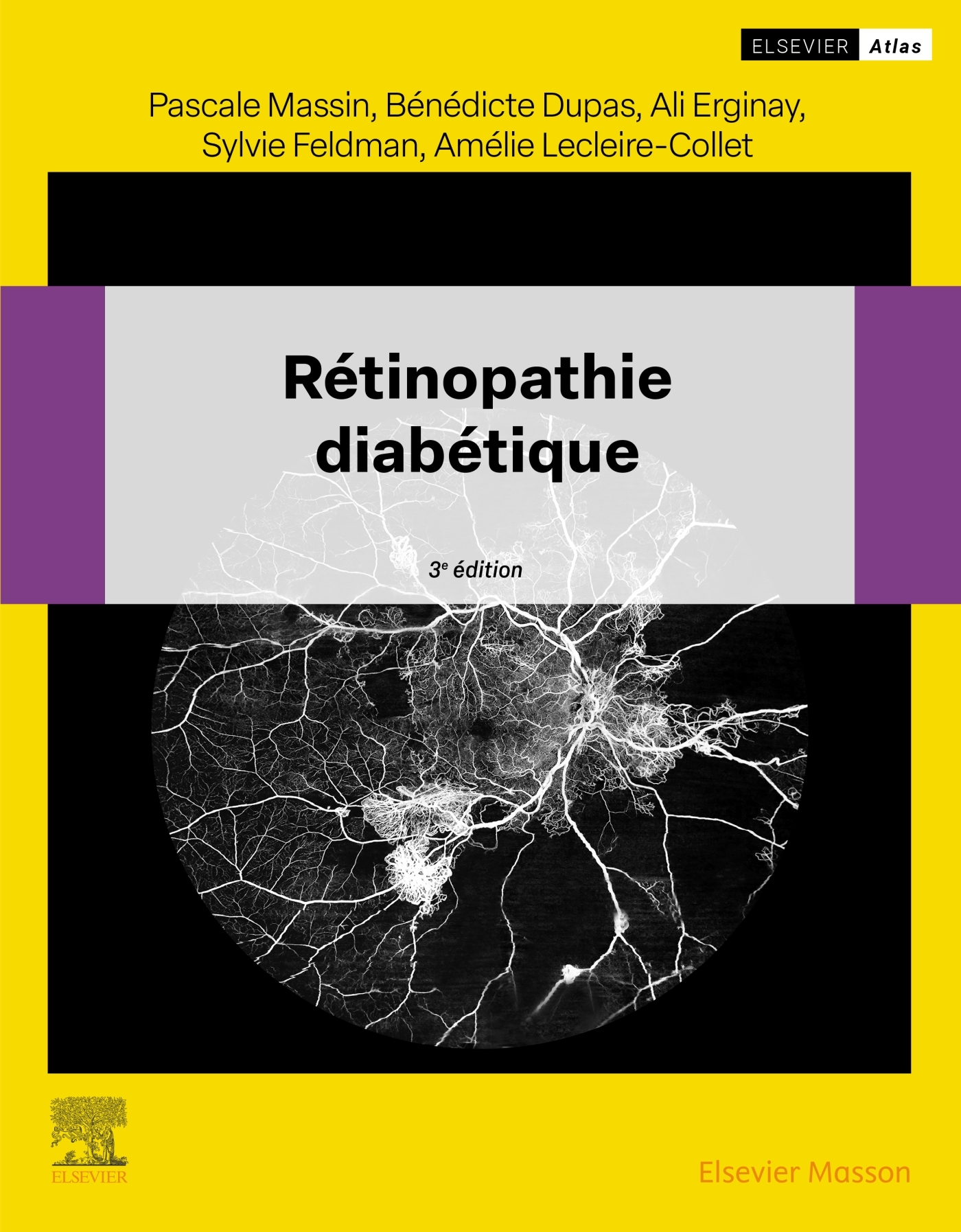 Rétinopathie diabétique