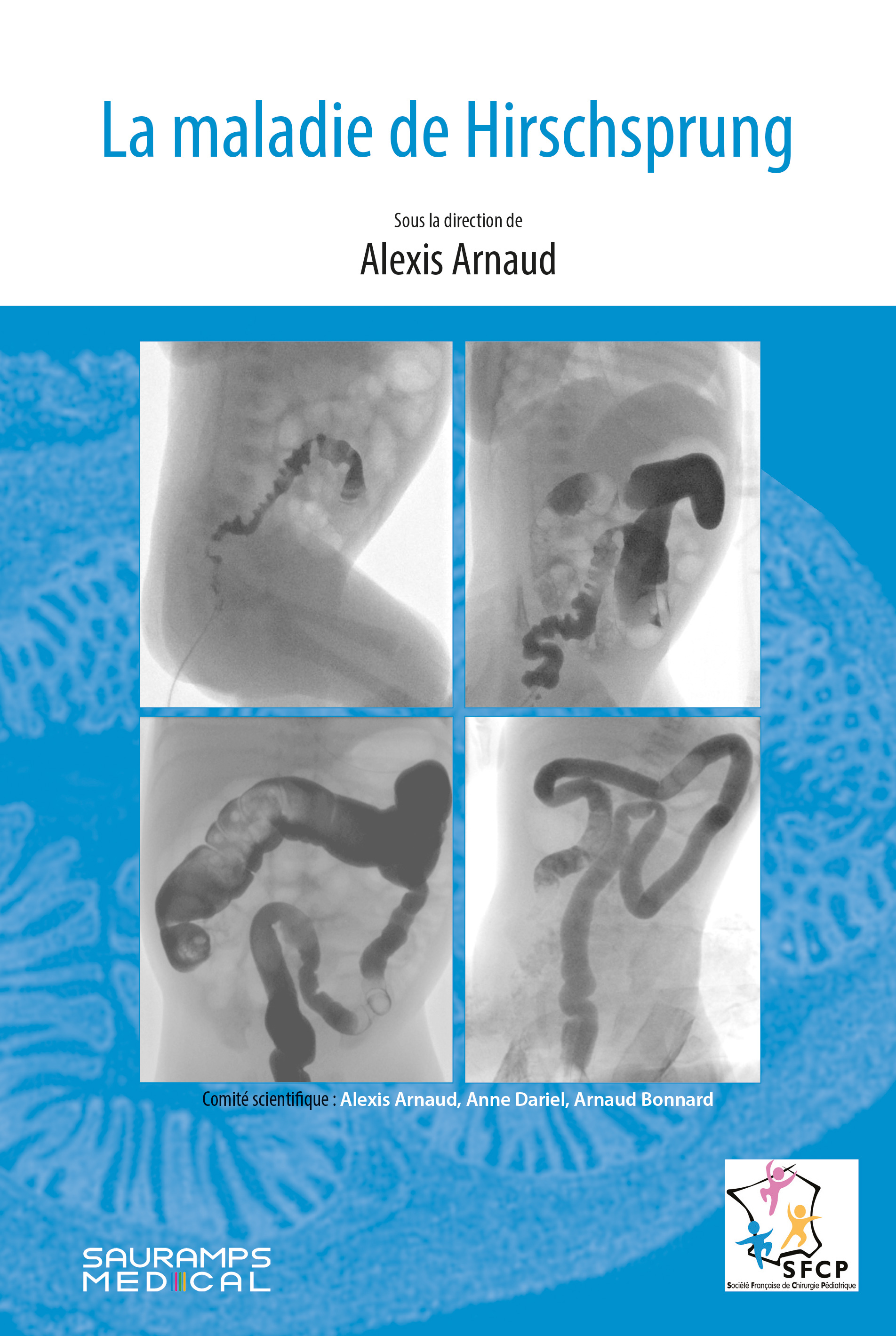 La maladie de Hirschsprung