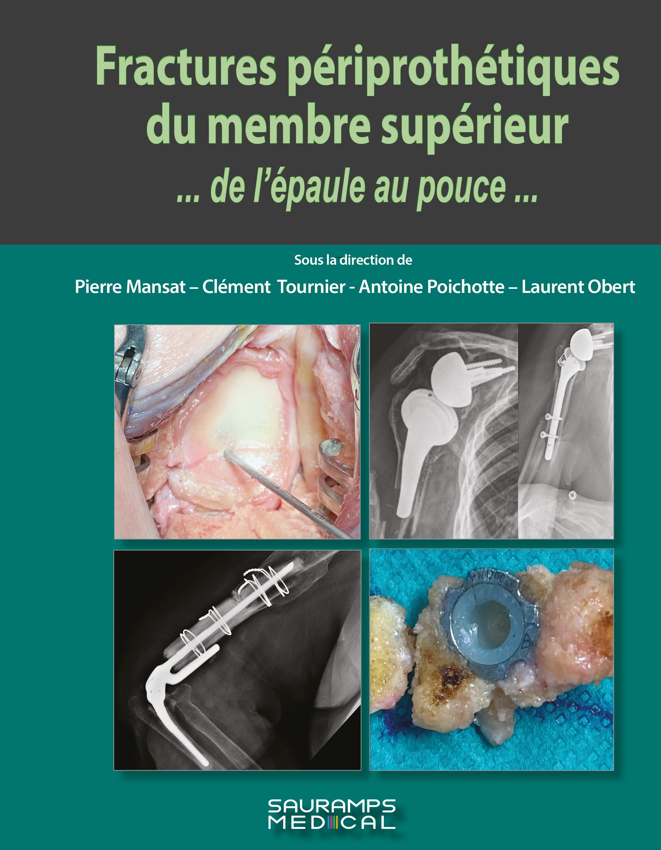 Fractures périprothétiques du membre supérieur...de l'épaule au pouce...