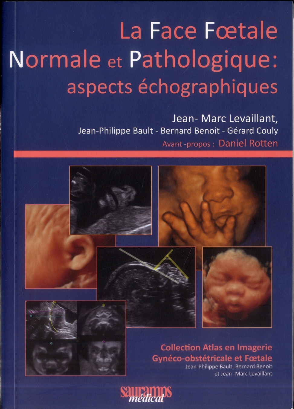 LA FACE NORMALE ET PATHOLOGIQUES : ASPECTS ECHOGRAPHIQUES