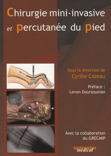 CHIRURGIE MINI INVASIVE ET PERCUTANEE DU PIED