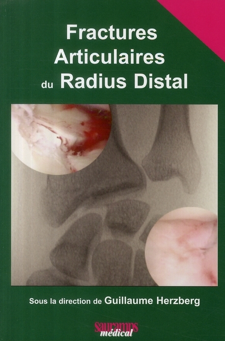 FRACTURES ARTICULAIRES DU RADIUS DISTAL