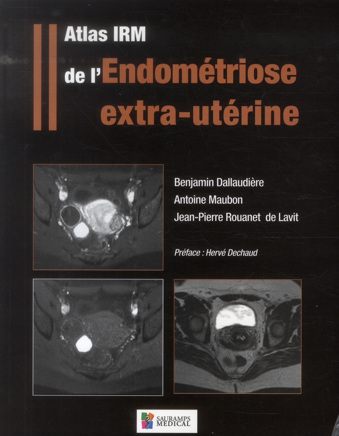 ATLAS IRM DE L'ENDOMETRIOSE EXTRA-UTERINE