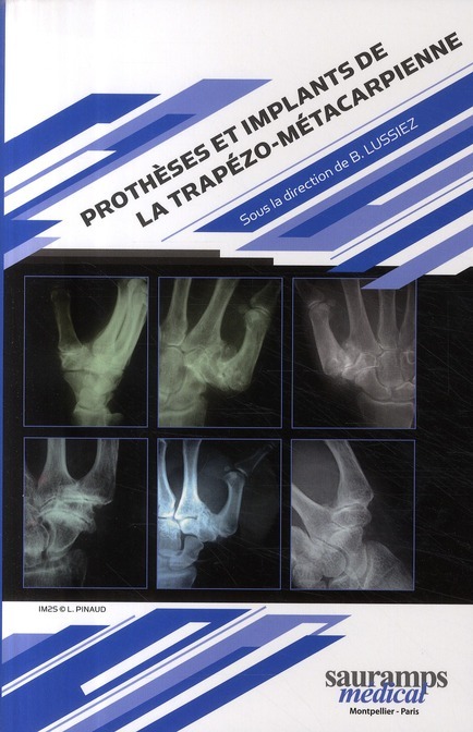 PROTHESES ET IMPLANTS DE LA TRAPEZO METACARPIENNE