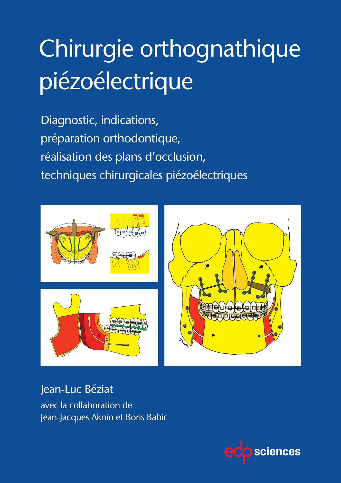 CHIRURGIE ORTHOGNATHIQUE PIEZOLECTRIQUE
