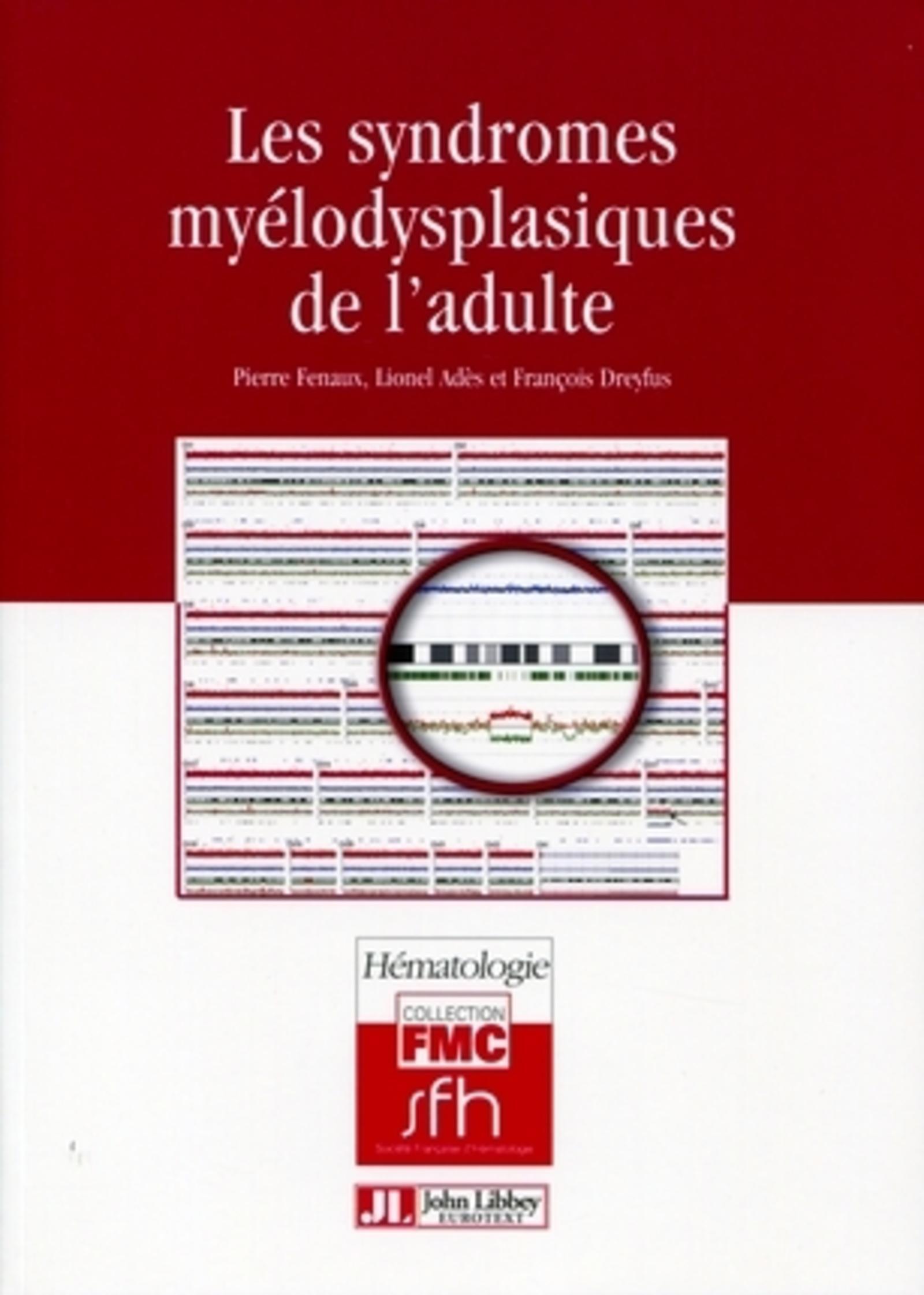 LES SYNDROMES MYELODYSPLASIQUES DE L'ADULTE