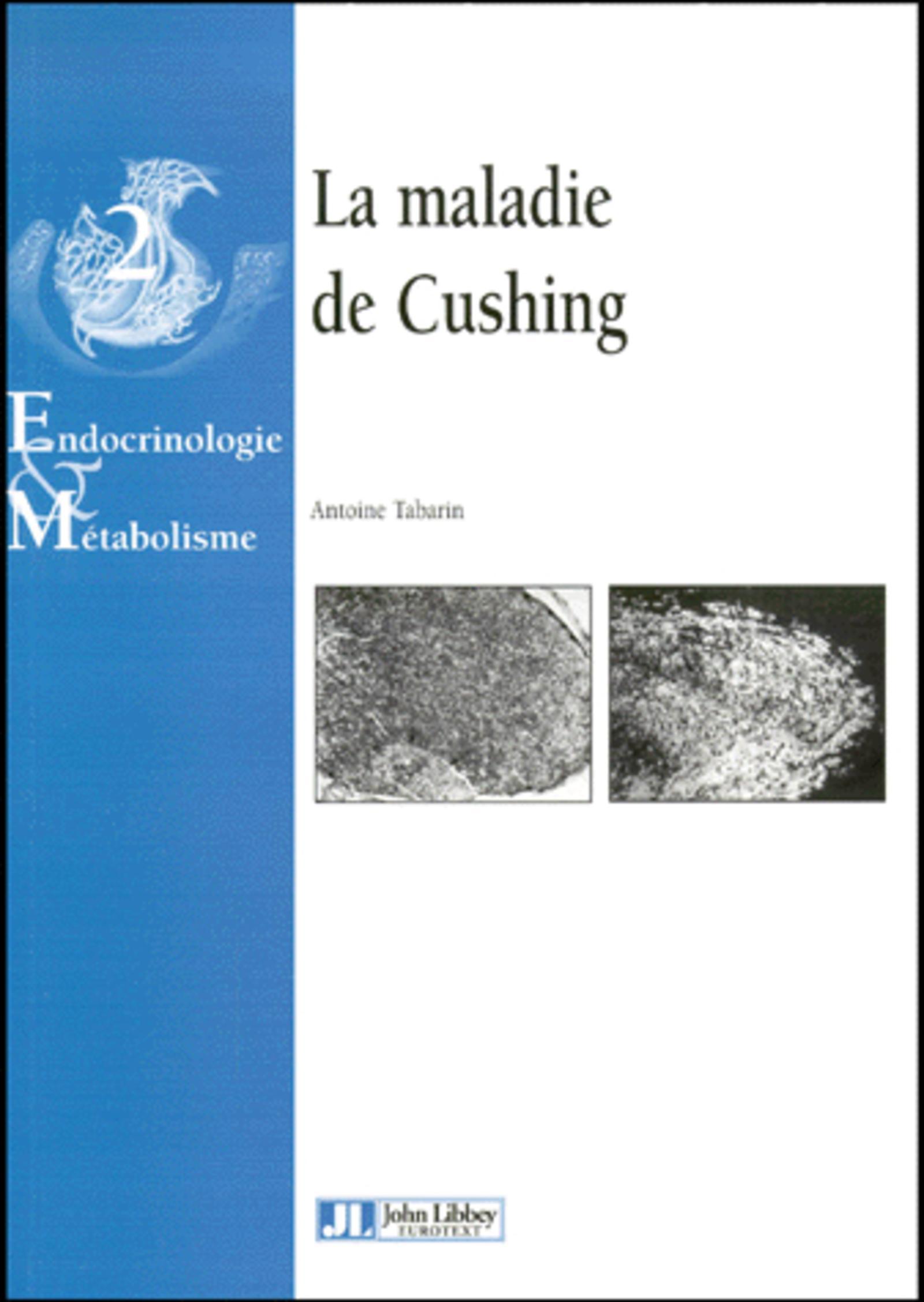 MALADIE DE CUSHING