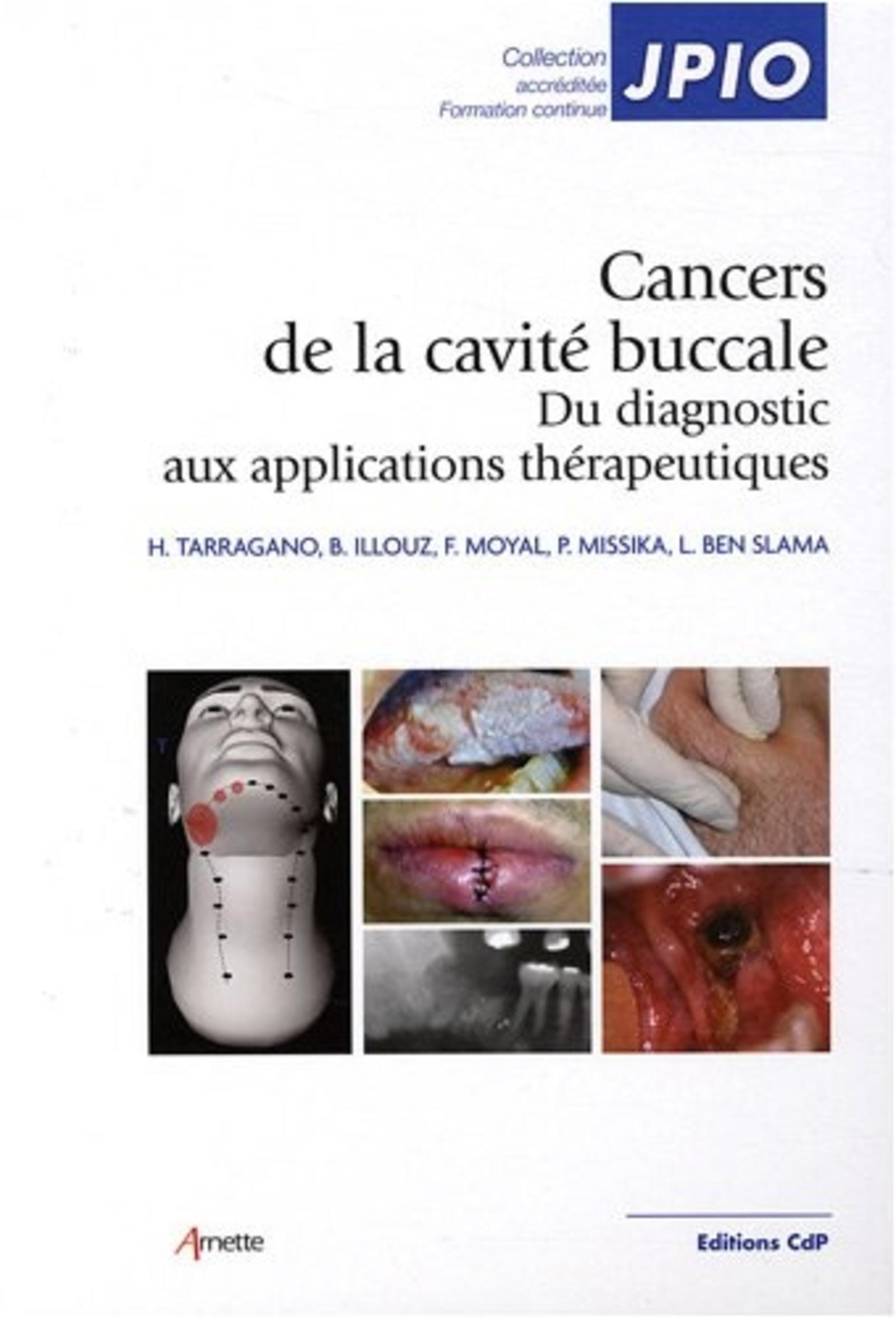 Cancers de la cavité buccale