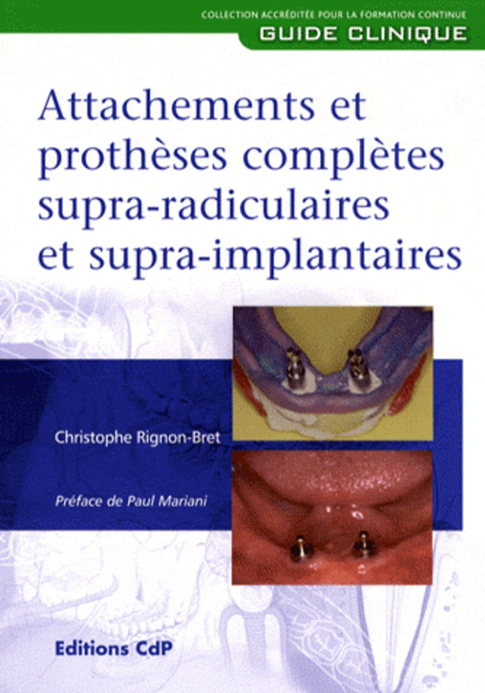 Attachements et prothèses complètes supra-radiculaires et supra-implantaires