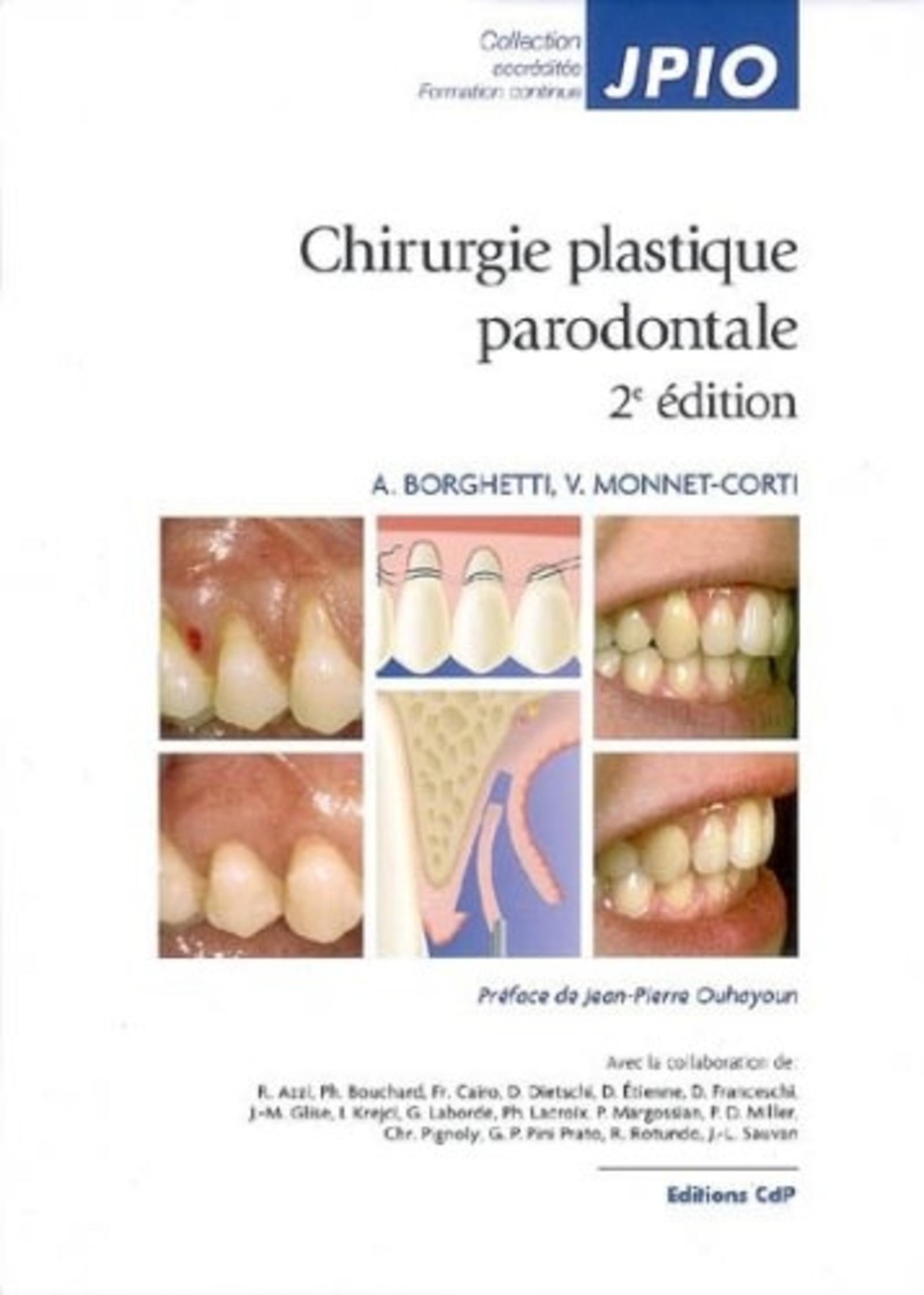 CHIRURGIE PLASTIQUE PARODONTALE 2EME EDITION