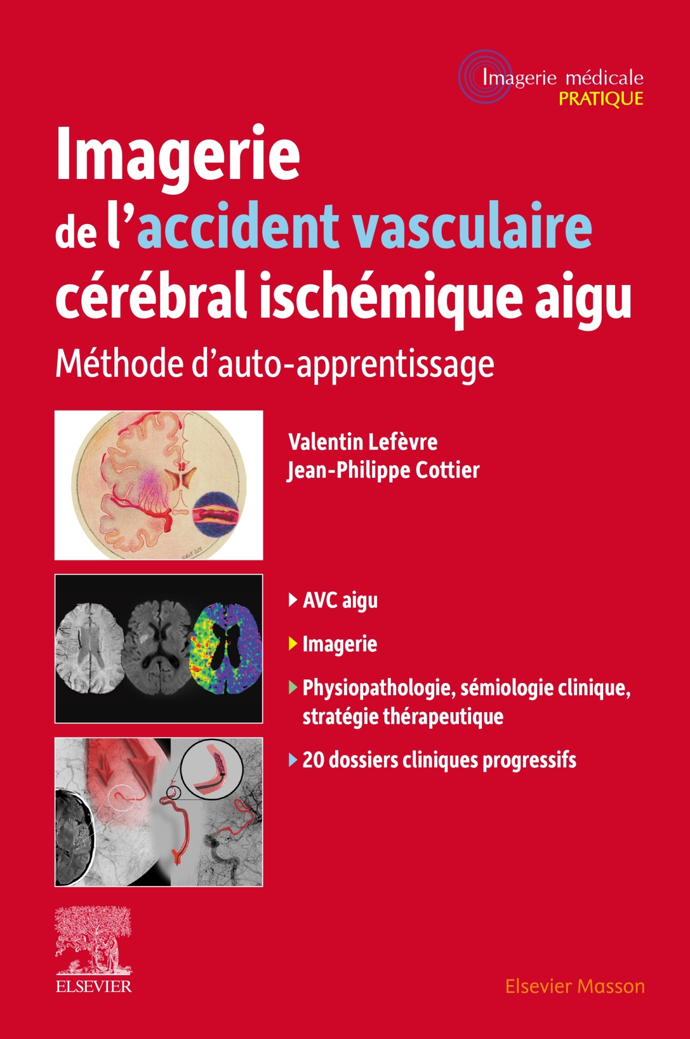 Imagerie de l'accident vasculaire cérébral ischémique aigu