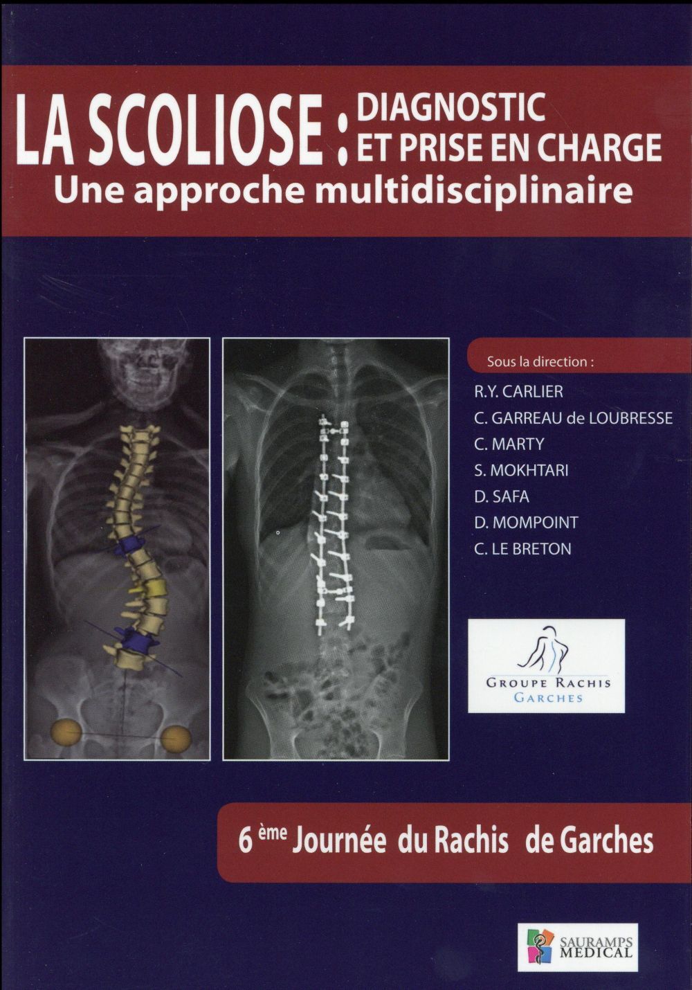 SCOLIOSE-DIAGNOSTIC ET PRISE EN CHARGE, UNE APPROCHE
